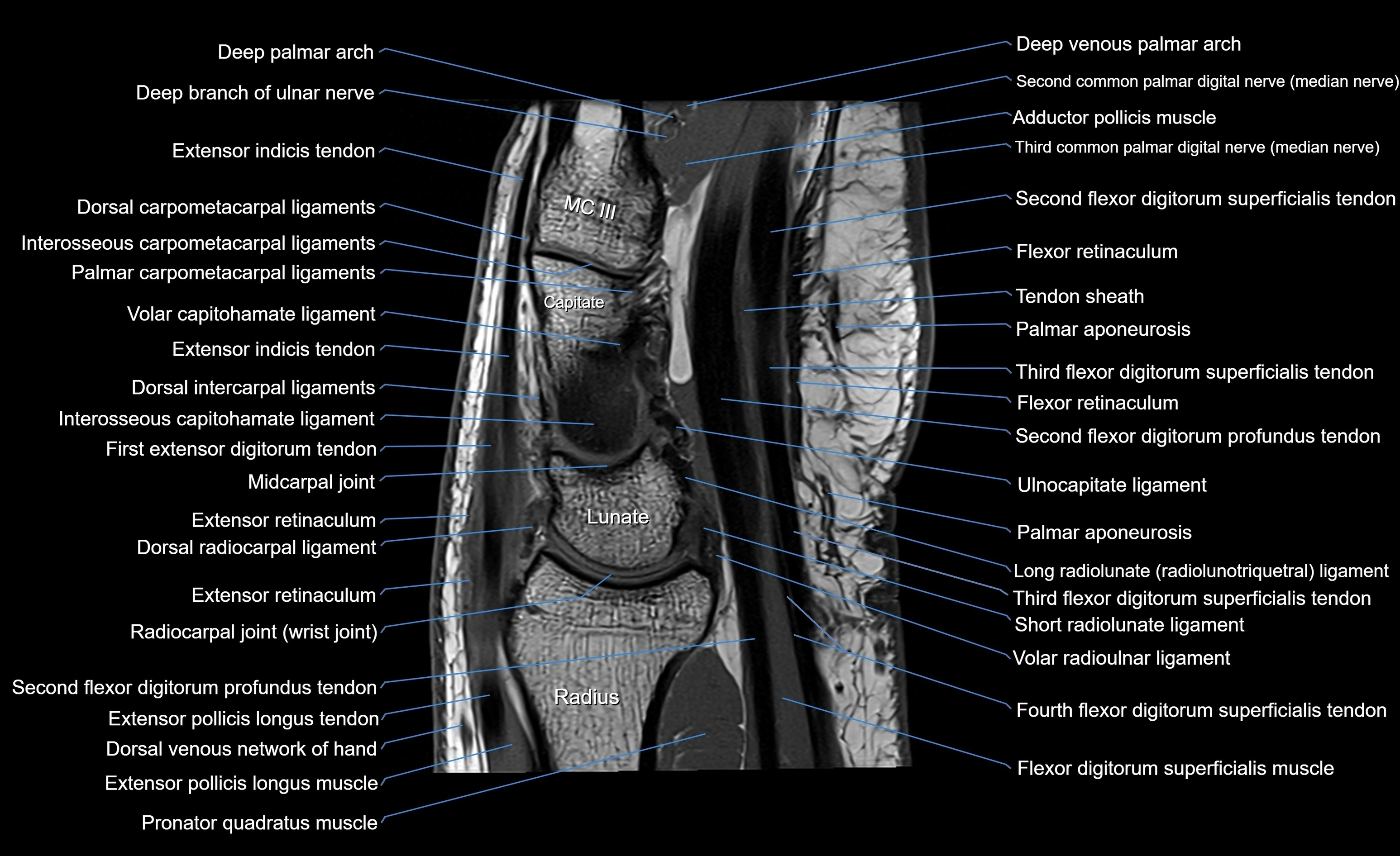 MRI wrist sagittal cross sectional anatomy 3T  radiology  image-img-00001-00014.webp